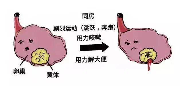 夫妻玩闹致妻子黄体破裂，警示与反思_反馈调整和优化