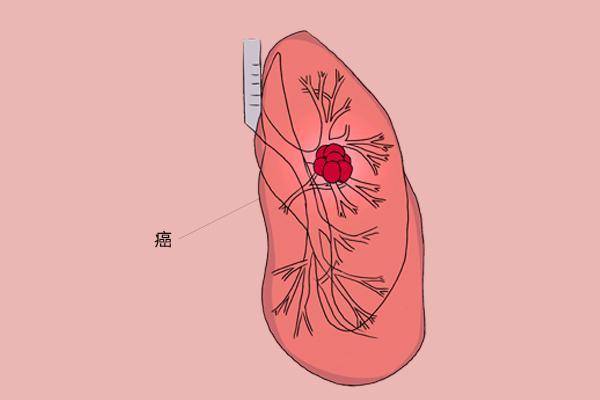 肺部结节癌症晚期后还有多长的生命时间_反馈调整和优化