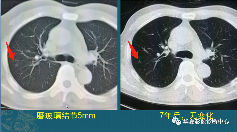 女子忽视肺结节终成肺癌晚期，警惕与反思_反馈分析和检讨