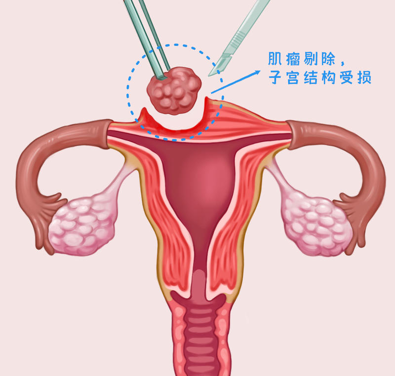 子宫肌瘤切除了还会复发吗？解析复发因素与应对策略