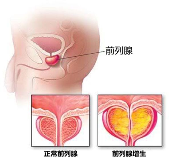 切除前列腺对寿命有影响吗？全面解读你的疑虑