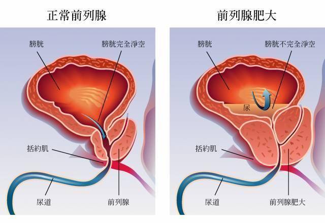 前列腺摘除术在我国的应用现状及其广泛普及的原因