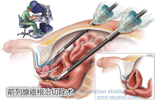 传统前列腺切除