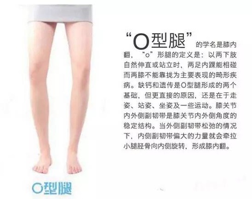 O型腿，解密你的腿型小秘密