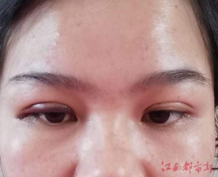 眼睛的秘密，女子双眼皮手术4年半后竟揉出手术针