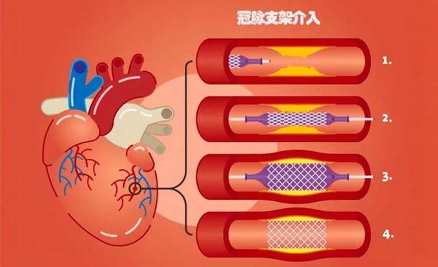 30岁心脏支架一年，我发生了什么样的变化…