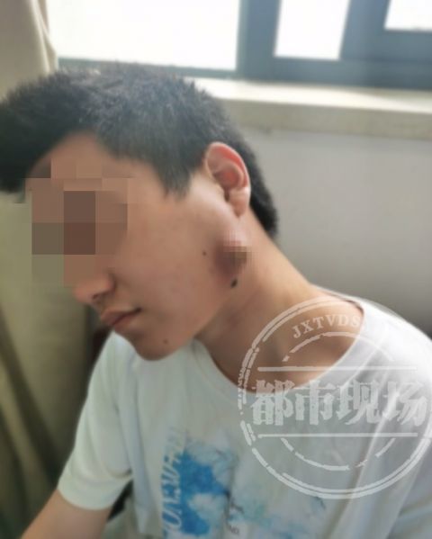 男子脸肿4天后意外吸住磁铁