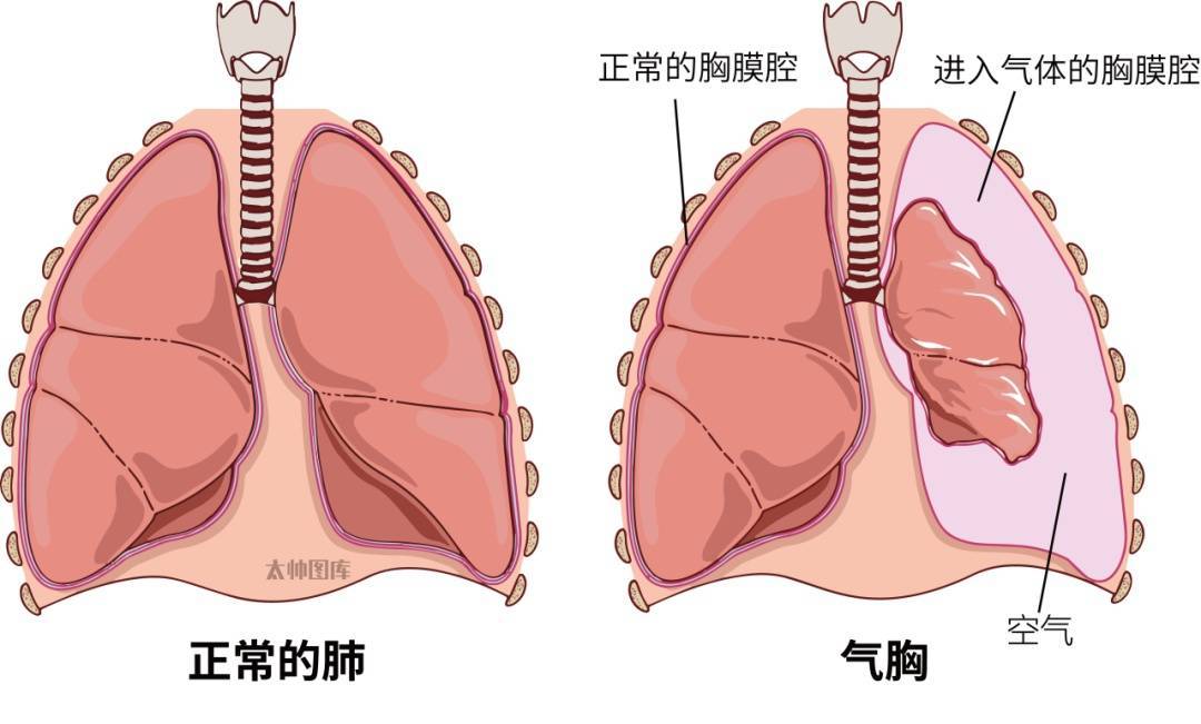 气胸降临，肺部沉默的危机，你还敢忽视这个健康警钟吗？