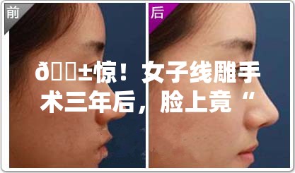 😱惊！女子线雕手术三年后，脸上竟“长”出一根线？！